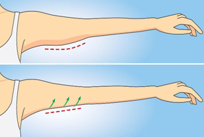 brachioplasty براکیوپلاستی