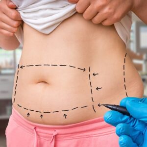 Abdominoplasty