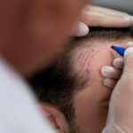 Free hair transplant consultation