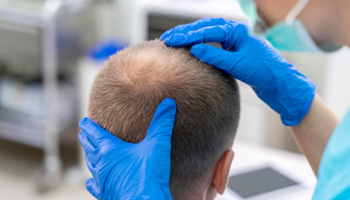 hair transplant