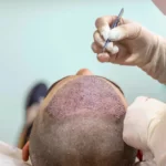 أفضل عيادة زراعة الشعر في طهران