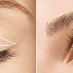 Eyelid surgery: A solution to remove puffiness and wrinkles on the eyelids